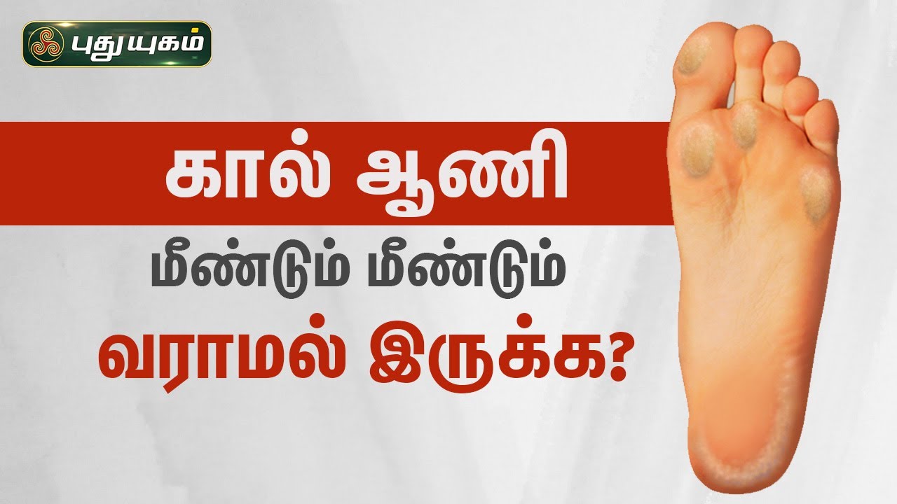 கால் ஆணி, மீண்டும் மீண்டும் வராமல் இருக்க? Dr.Jayaroopa | Iniyavai Indru | PuthuyugamTV