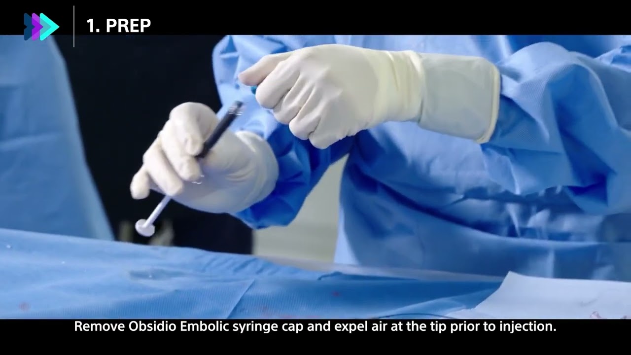 Obsidio&trade; Conformable Embolic deployment in three steps