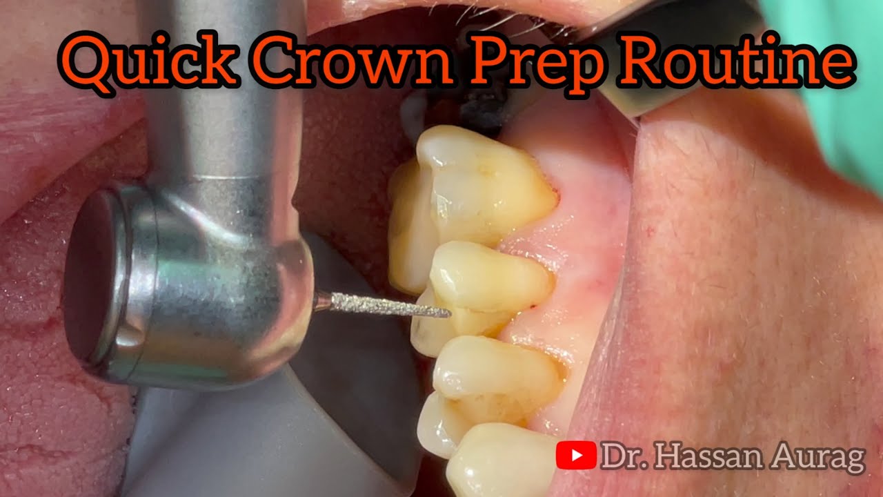 Step-by-Step Crown Preparation: Upper Molar & Premolar 🦷