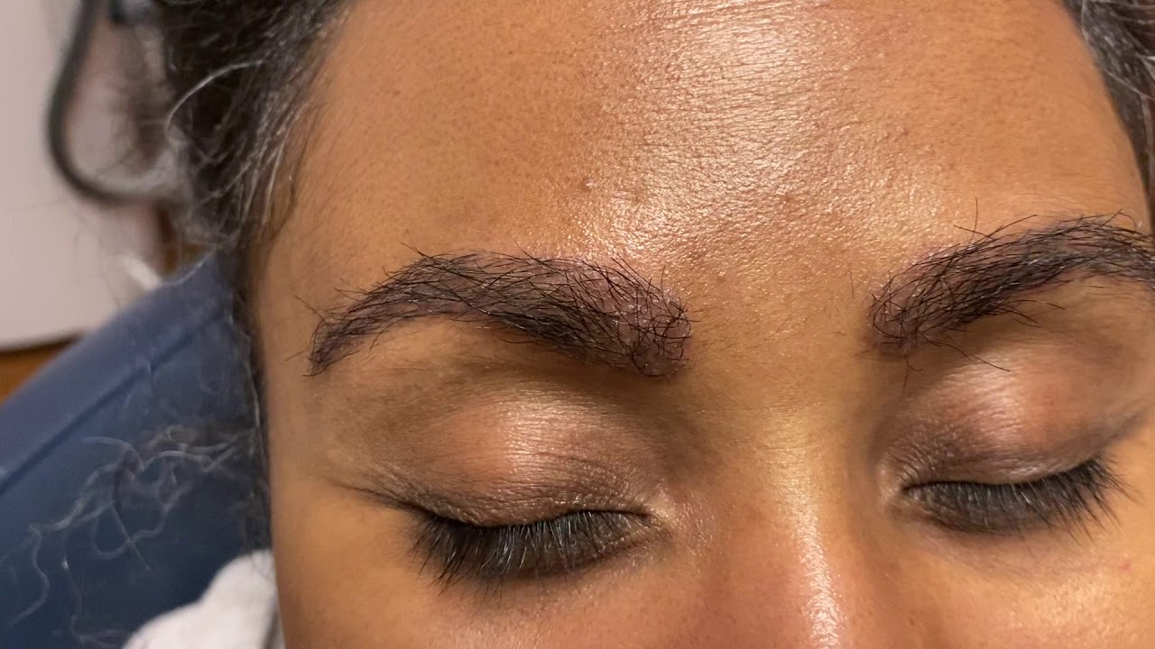 Dallas African-American Eyebrow & Hairline Transplant 2 Weeks Out