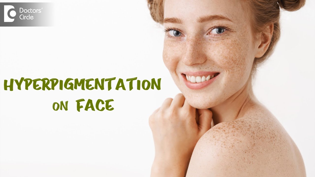 HYPERPIGMENTATION ON FACE | Causes, Prevention & Treatment - Dr. Urmila Nischal | Doctors' Circle
