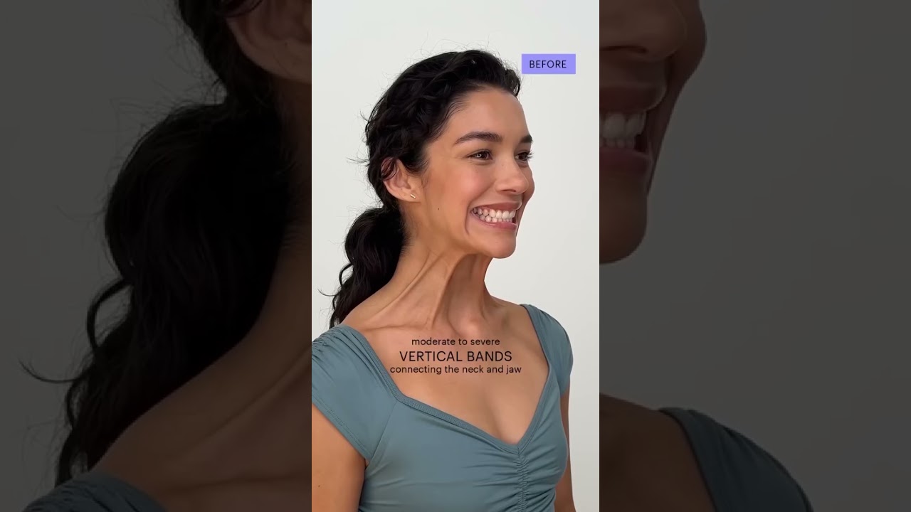 Platysmal Band Botox for Neck Rejuvenation | Smooth & Redefine the Neckline