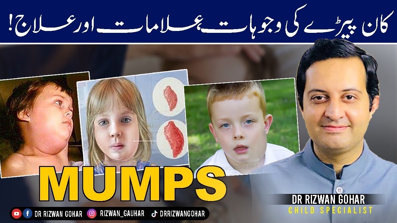 MUMPS SYMPTOMS & HOME TREATMENT #Mumps #treatment