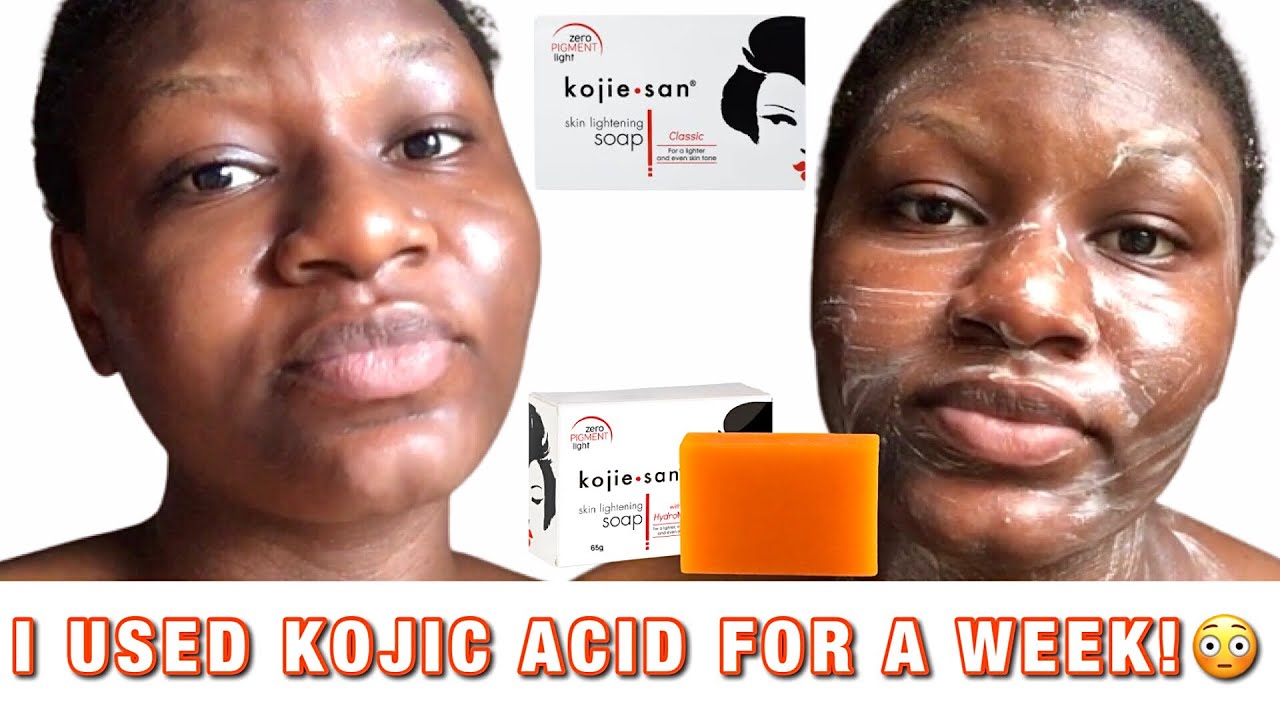 I USED KOJIC ACID FOR A WEEK😬 & THIS HAPPENED!😩💔 | KOJIE SAN REVIEW | REGRETS?!