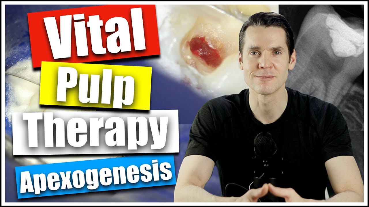 Mechanical Pulp Exposure with Vital Pulp Therapy, William Nudera, Endodontist
