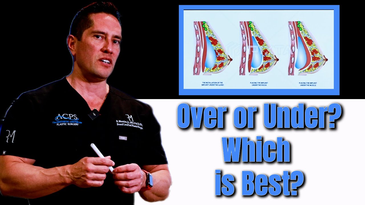 Грудные имплантаты: сверху или снизу — что лучше?