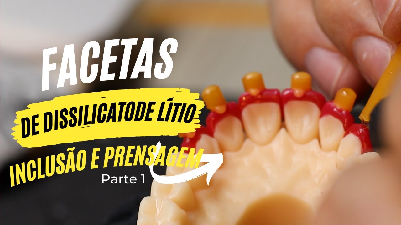 Facetas com Dissilicato de Lítio Inclusão e Prensagem