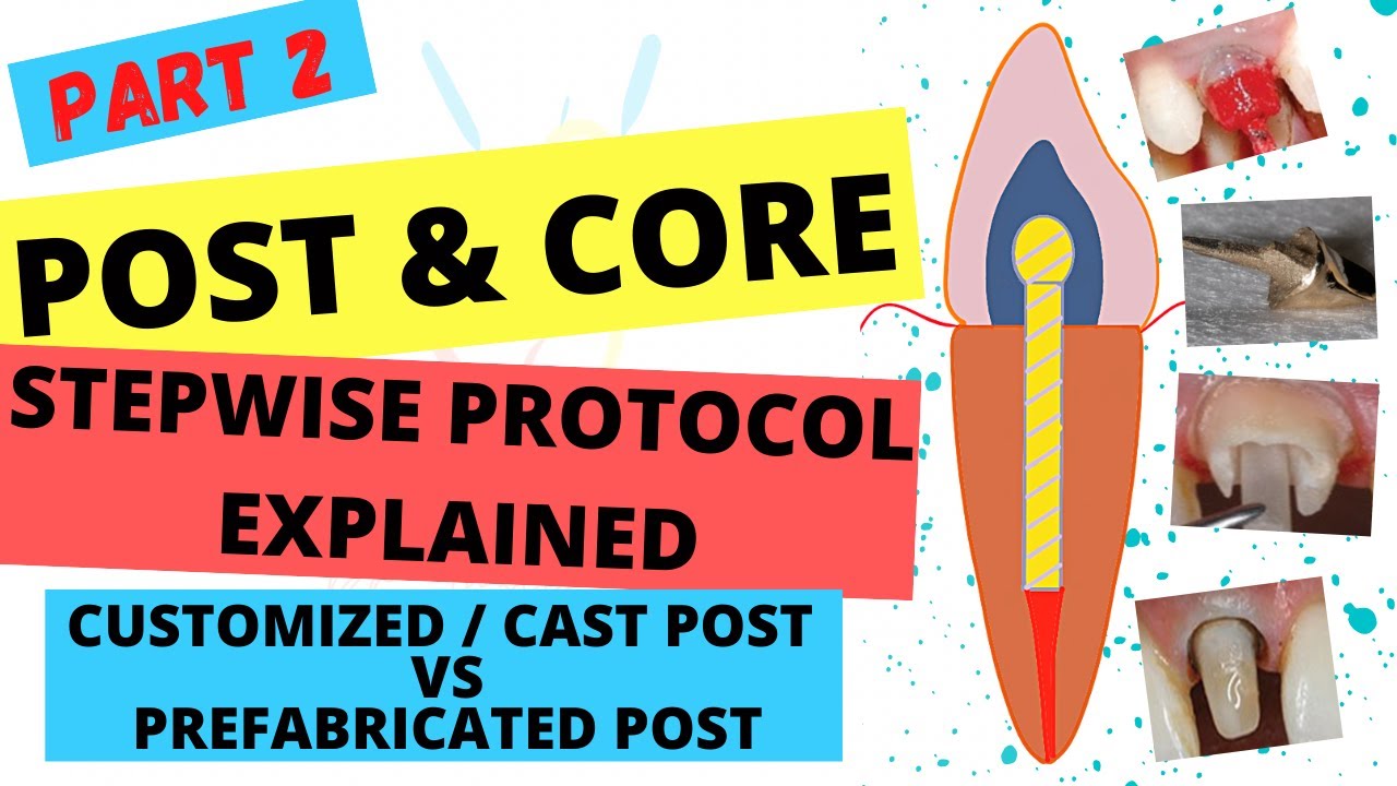 POST AND CORE  (Part-2) / SIMPLE STEPS FOR POST & CORE PROCEDURE / Customized VS Prefabricated Post.