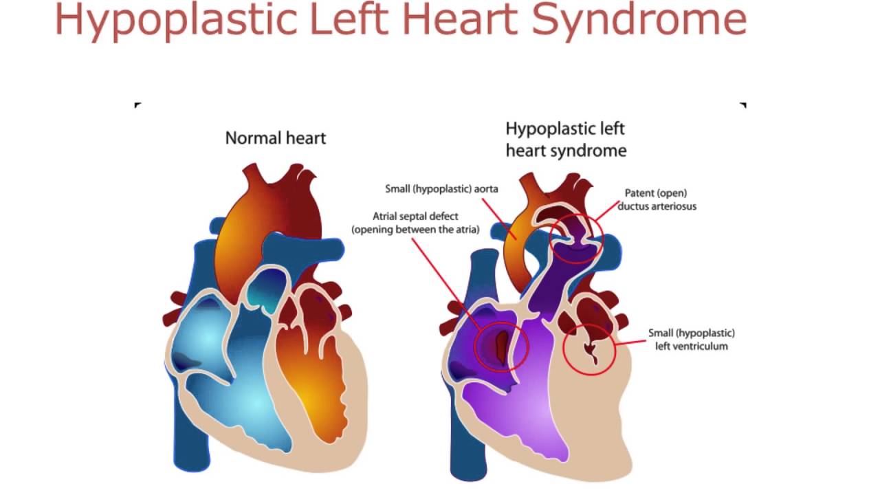 What is a Fontan Repair?