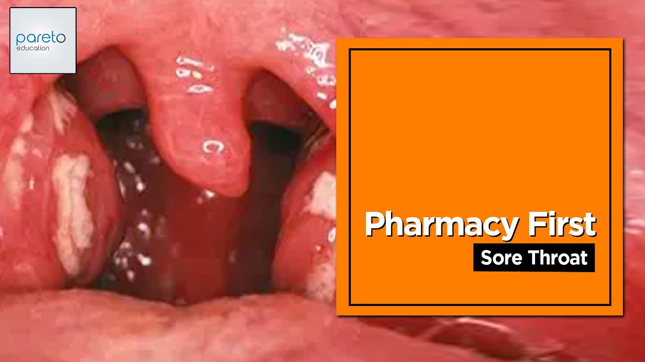 Pharmacy First | Sore Throat | Pareto Education