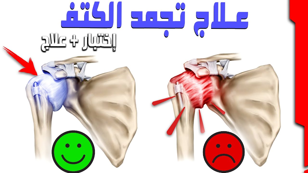 تجمد مفصل الكتف | علاج خاص لإزاله الإلتصاقات وعلاج الألم والطقطقة