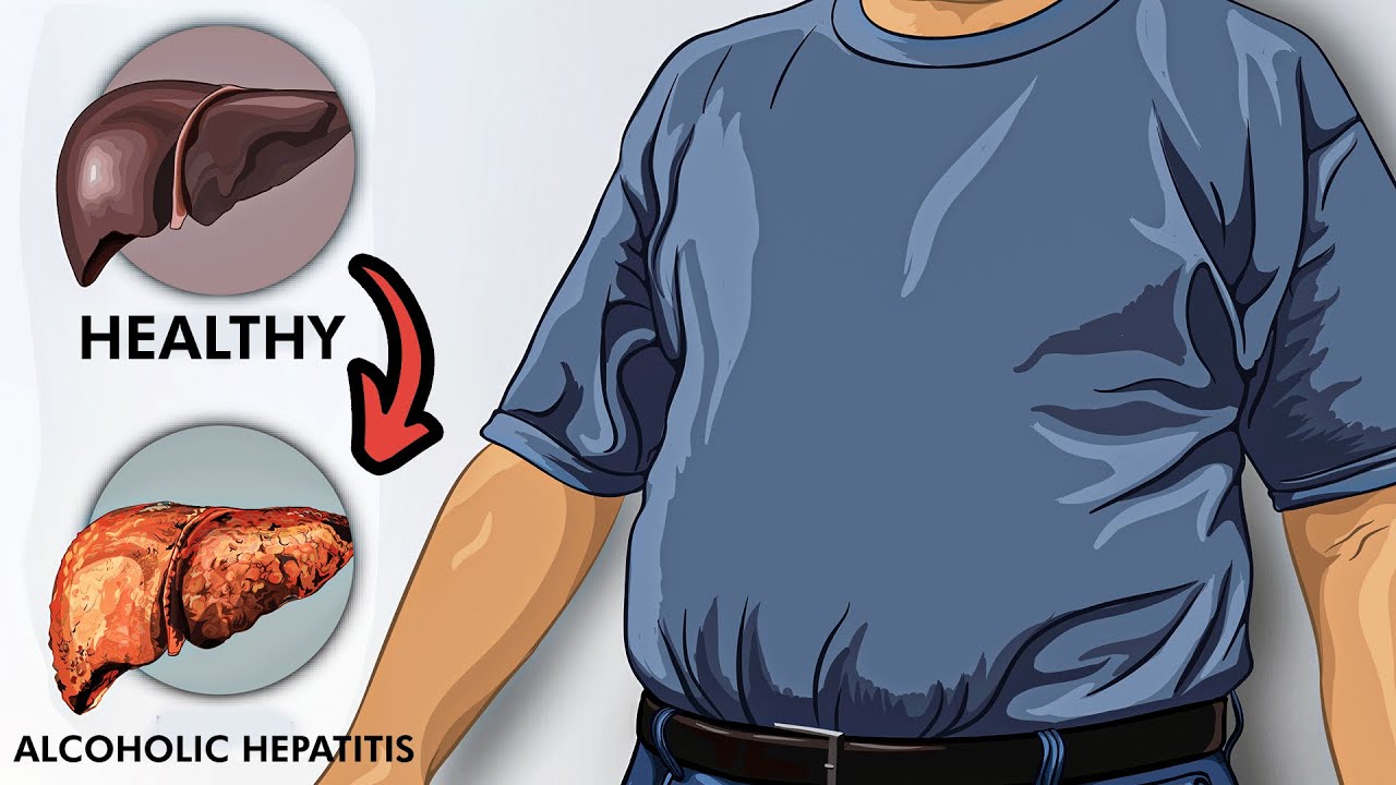 Alcoholic Hepatitis: Pathophysiology, Signs and Symptoms, Diagnosis and Treatment