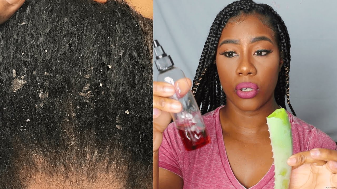 How to get rid of dry itchy scalp,flakes,seborrheic dermatitis,eczema, & psoriasis