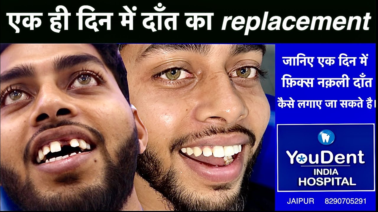 YouDent India Hospitals | एक ही दिन में दाँत का Replacement | Fixed Dental Implant Jaipur