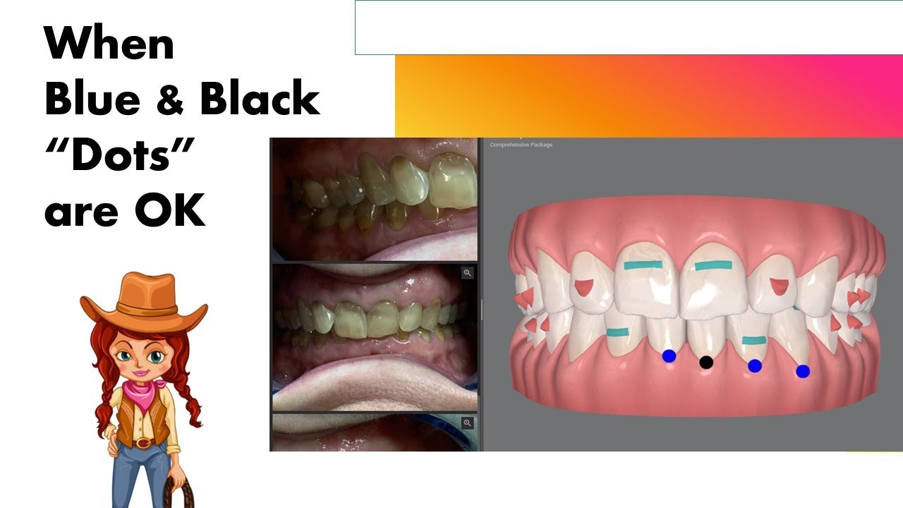 Invisalign ClinCheck - When blue and black dots are OK!