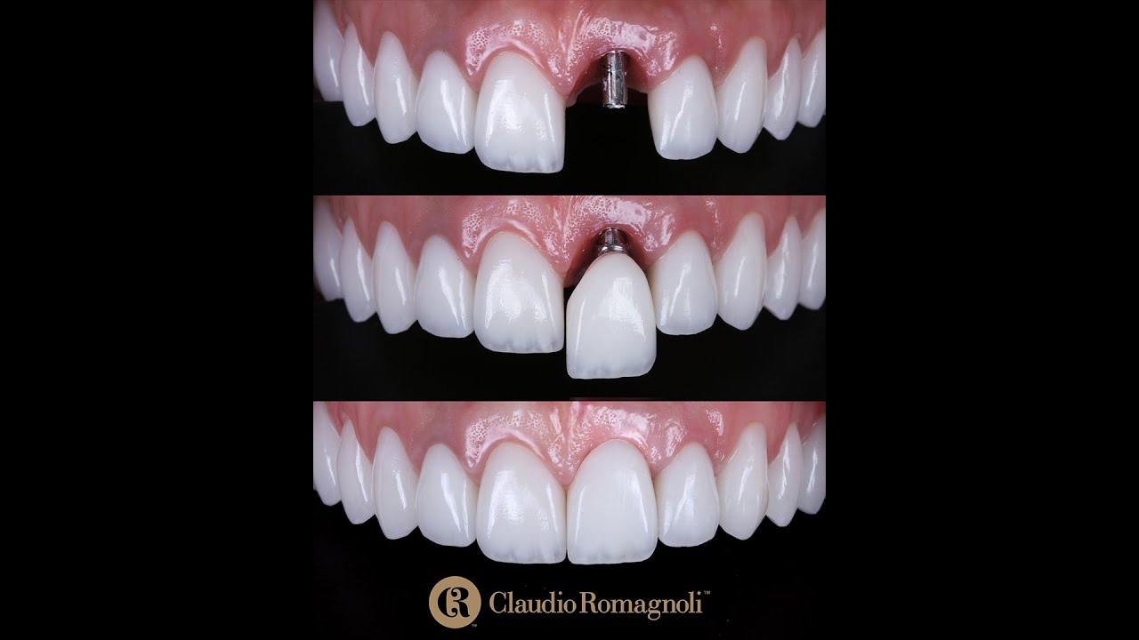 Casos Clínicos: Facetas de Porcelana e Implante Dentário Central | Dr. Claudio Romagnoli