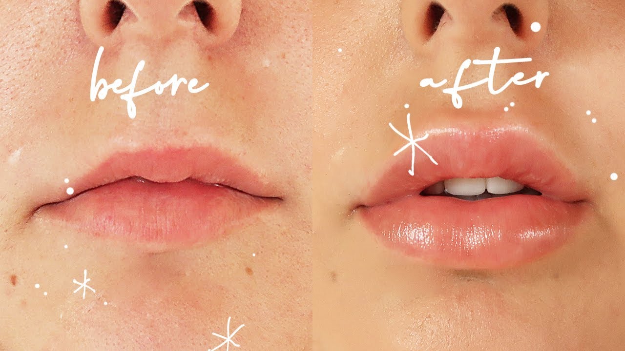 Getting Lip Injections! * Before & After (VLOG)