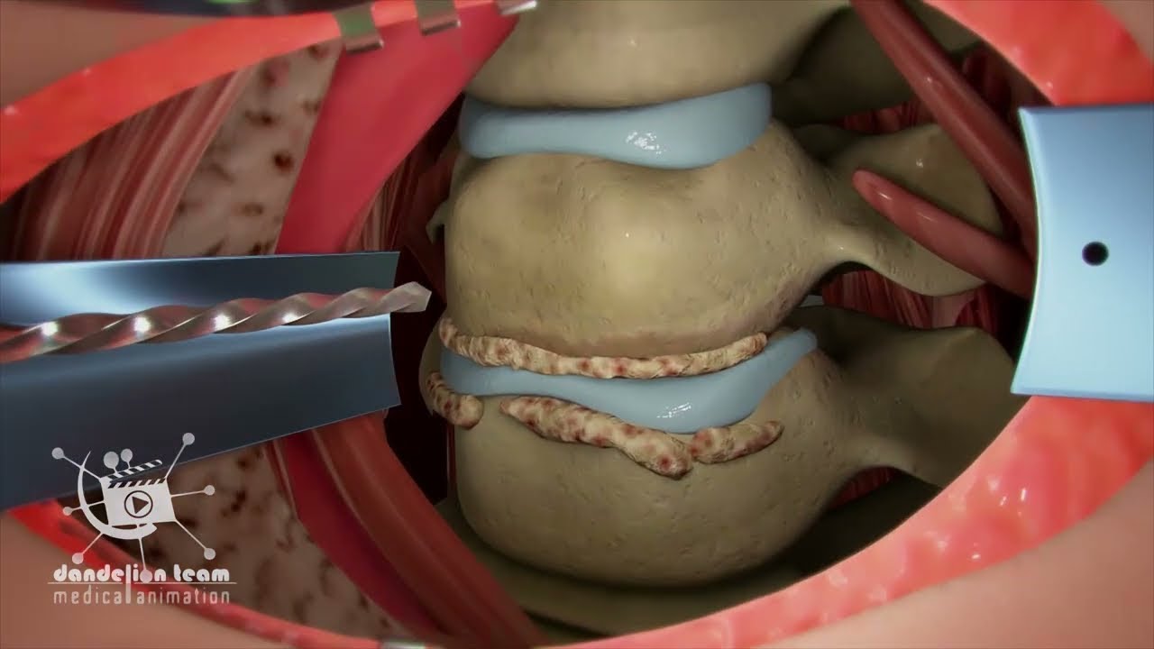 شاهد عملية ازالة الغضروف _ lumbar discectomy