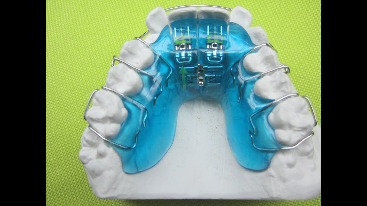 Dehnplatte 3/4 Zahnspange Schwarz Retainer Active Plate Kieferorthopädie Orthodontics