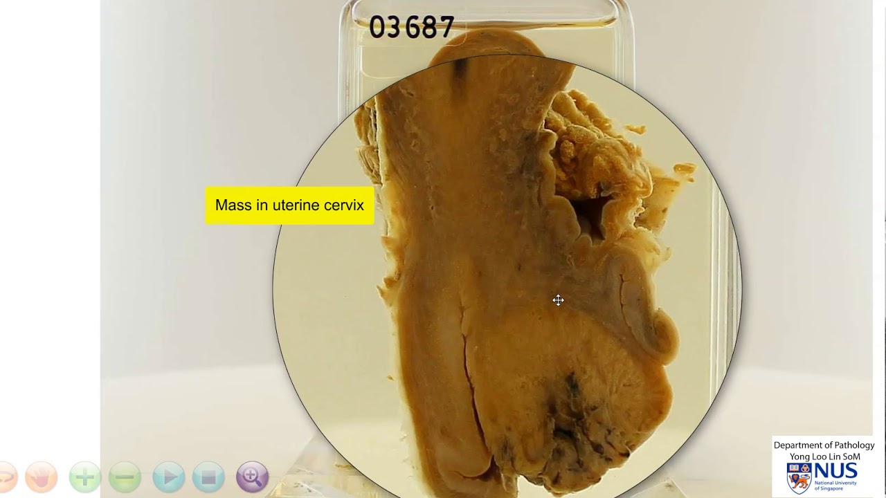 Uterus and cervix - Cervical carcinoma
