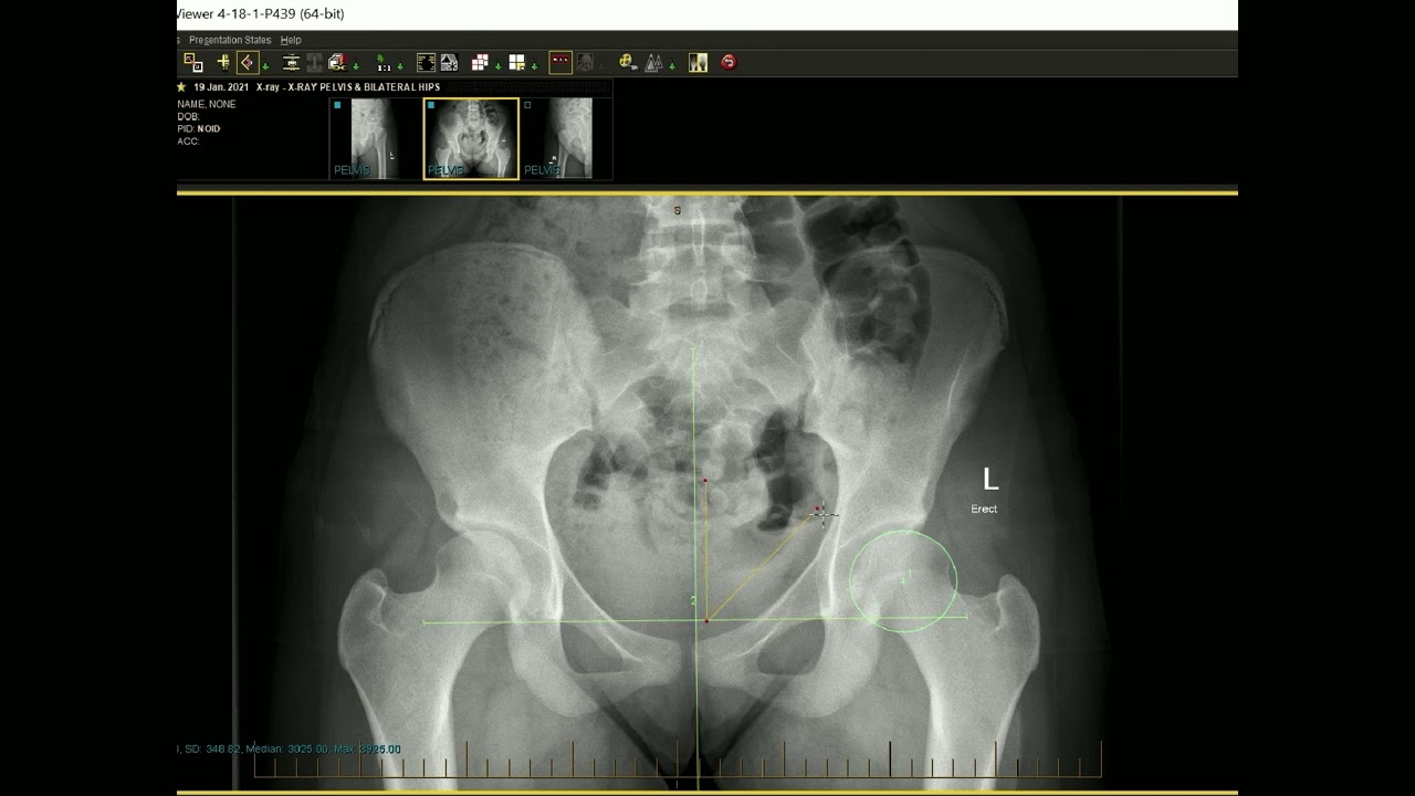 Adult Hip Dysplasia Masterclass - Dr Michael O'Brien & Alesha Coonan | Official Preview