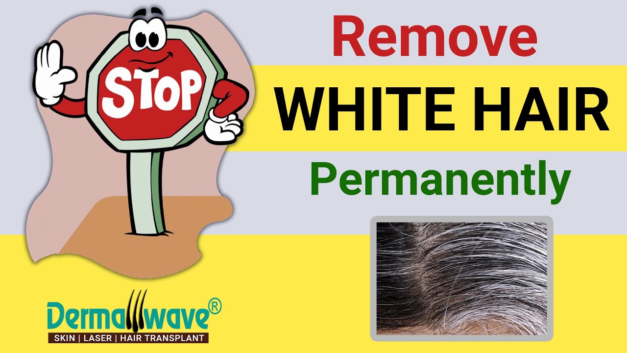 Remove White Hair Permanently | White Hair Extraction by FUE | Electrolysis For White Hair Removal