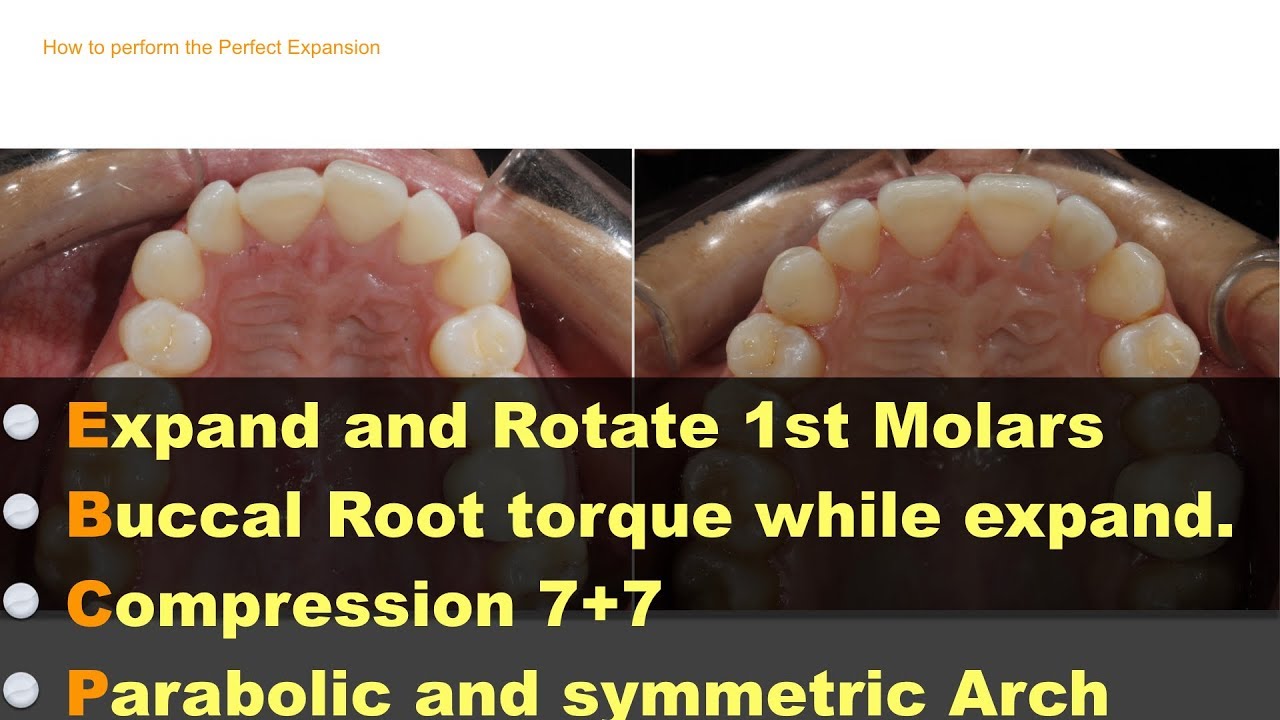 Protocols for expansion using Invisalign aligners