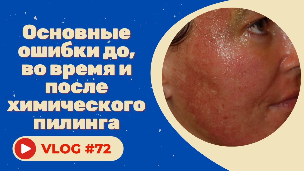 Основные ошибки до, во время и после химического пилинга