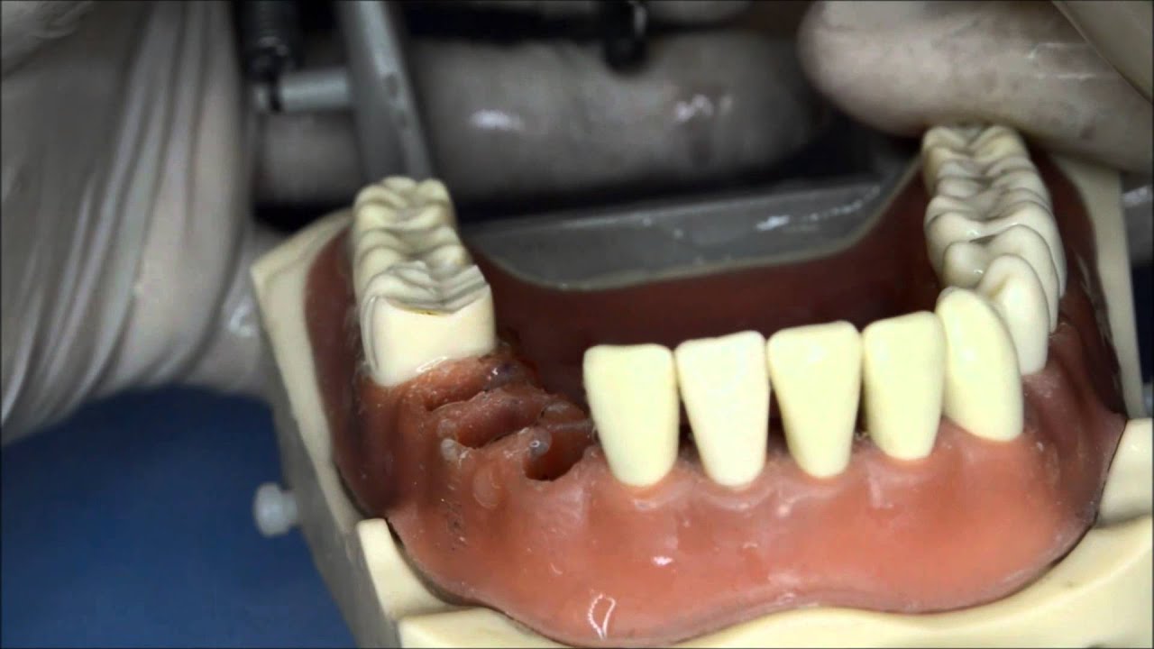 Tallado molar 46 parte 1