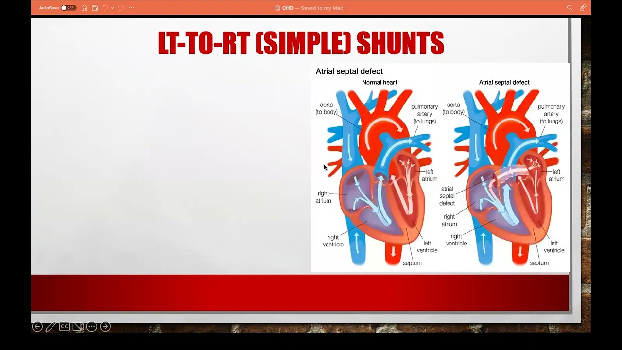 Anesthesia for Congenital heart diseases (CHD), Part-1