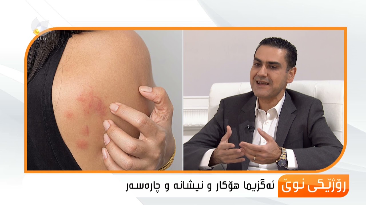 ئەگزیما چییە و هۆكارو نیشانەكانی چین ؟بڕیار تەیب