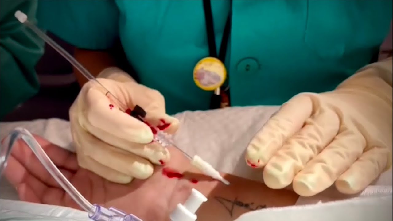 Cómo monitorizar presión arterial invasiva PAI