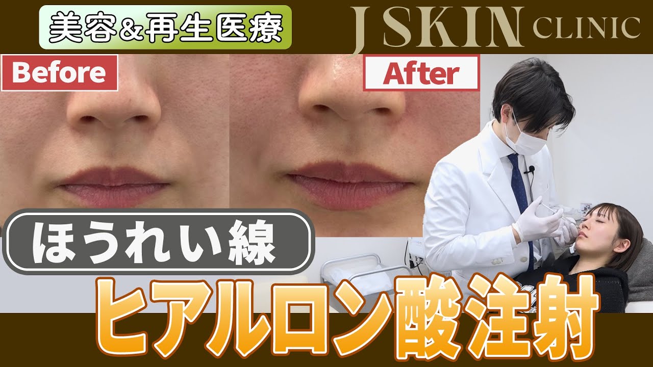 【Dr.牧野潤】気になるほうれい線にヒアルロン酸注射！【施術動画】