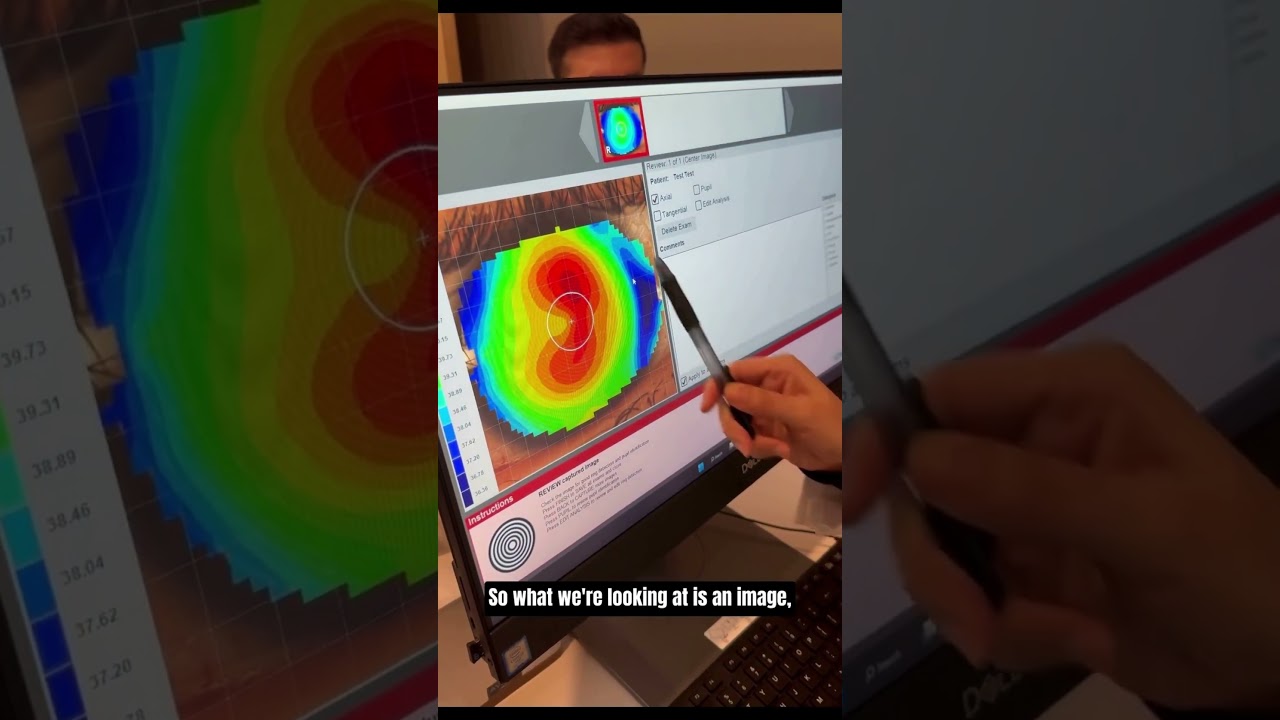 Understanding Corneal Topography