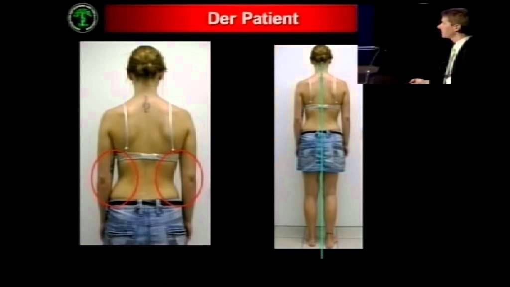 Skoliosebehandlung bei Kindern mittels Physiotherapie