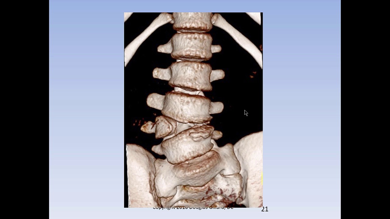 Congenital Scoliosis