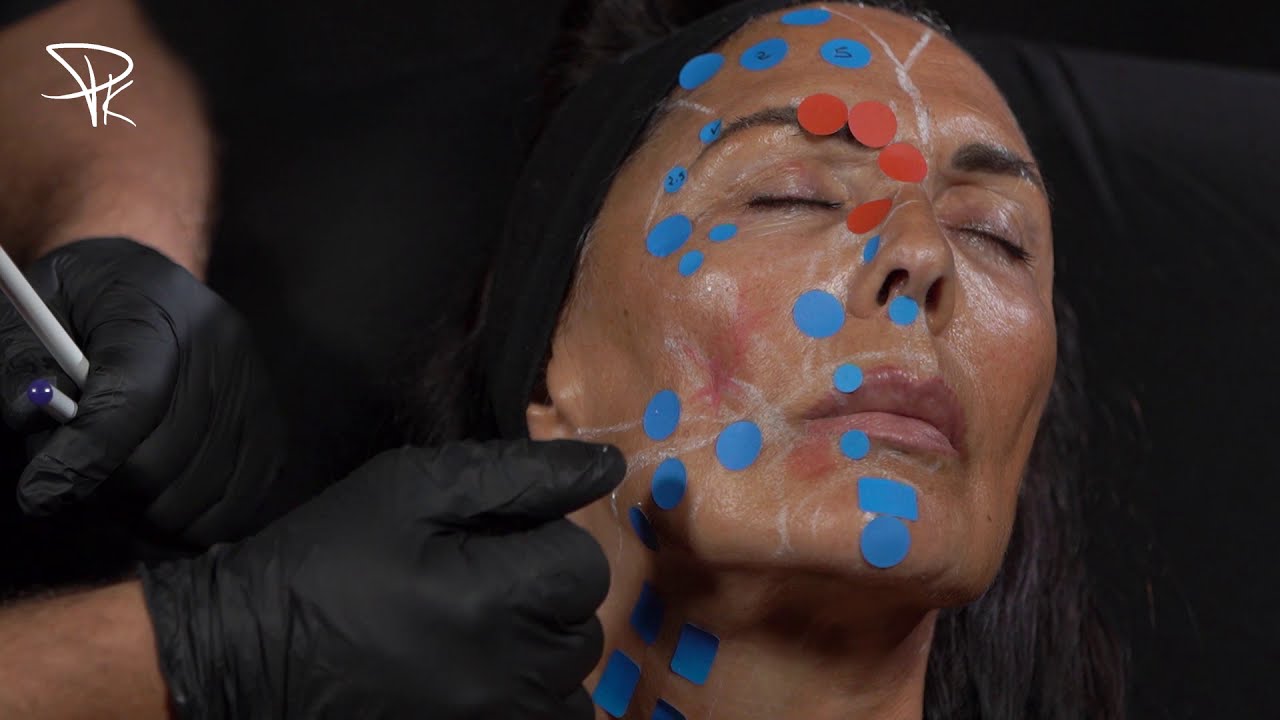 Le rajeunissement facial : Technique et injections (Point théorique / les zones d'injections)