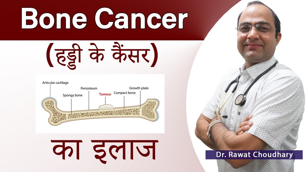 Bone Cancer Treatment | हड्डी के कैंसर का इलाज | बोन कैंसर | Best Doctor for Cancer