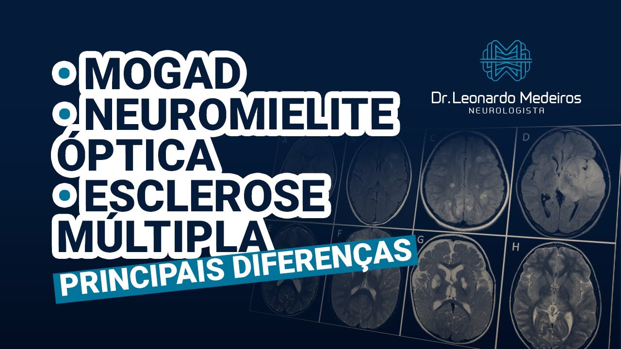 MOGAD, Neuromielite Óptica e Esclerose Múltipla: principais diferenças