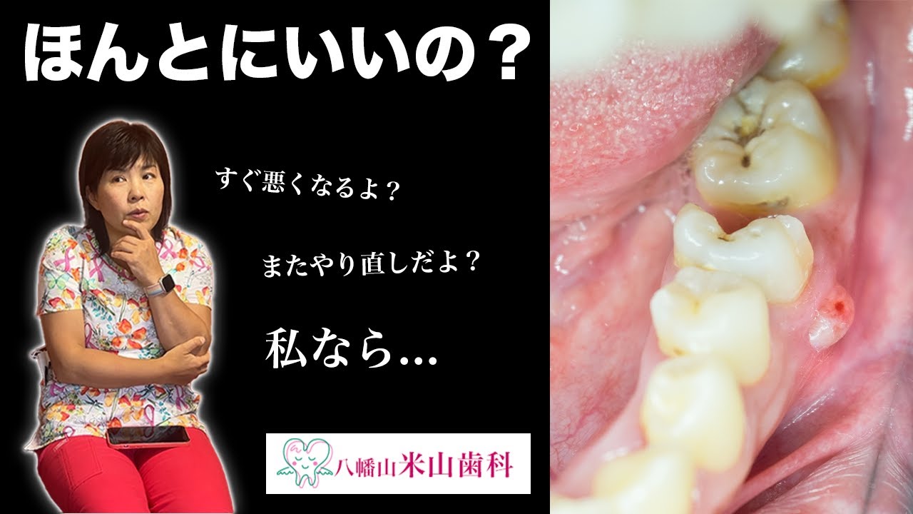 【失敗する前に】「奥歯の詰め物」歯医者さんなら何を選ぶ？