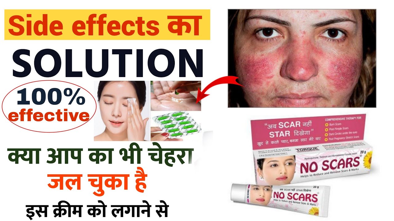 No scars cream के साइड इफेक्ट को ऐसे ठीक करें | No scars cream side effects solution |