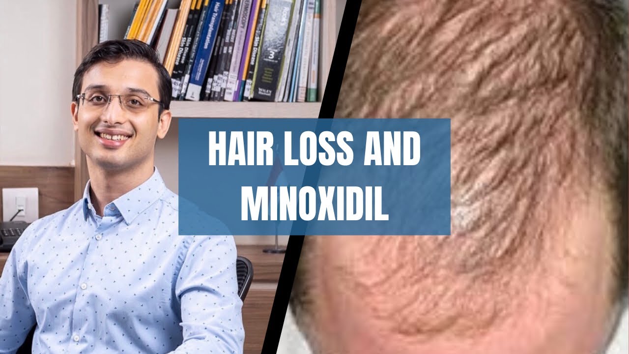 Minoxidil for hair loss ( Which minoxidil is best for your hairloss) | DR. ANKUR SARIN |
