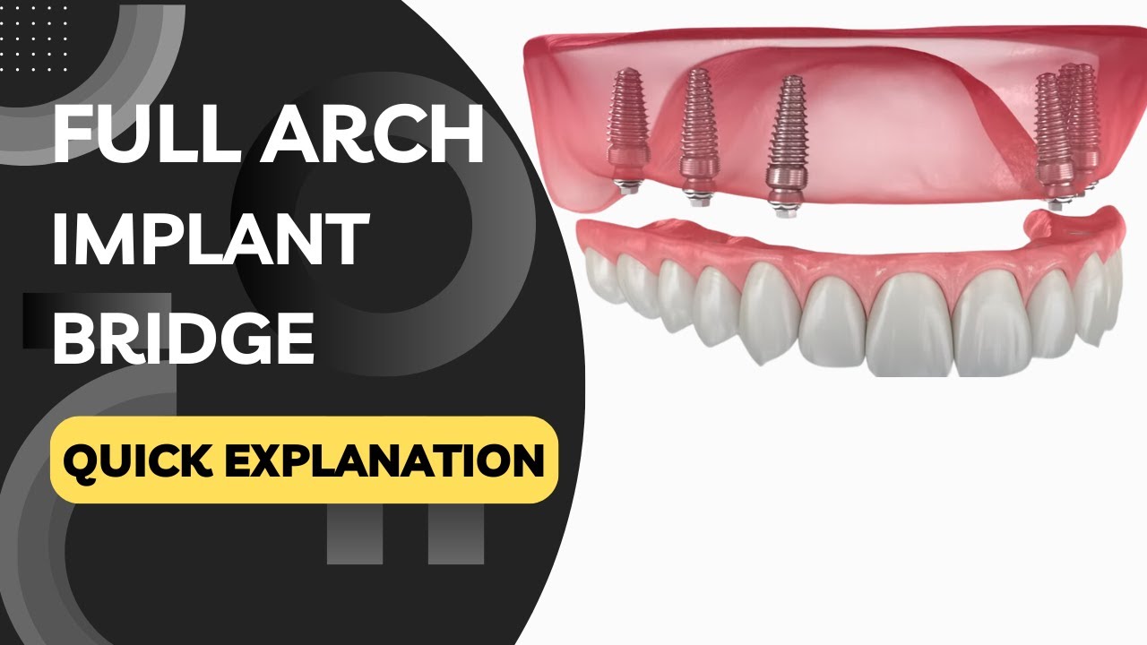 What is a Full Arch Implant Bridge? Quickly Explained in a Few Seconds!