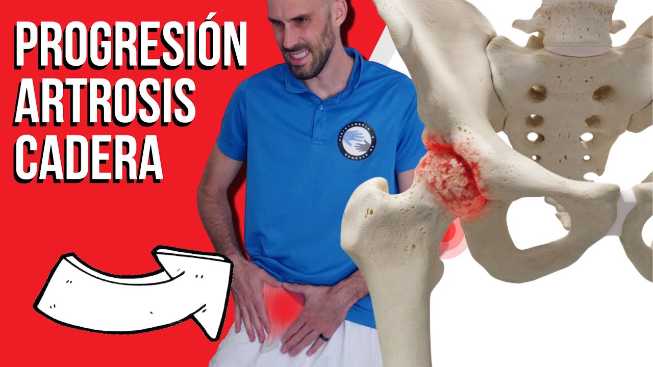 Progresión de ejercicios para artrosis de cadera