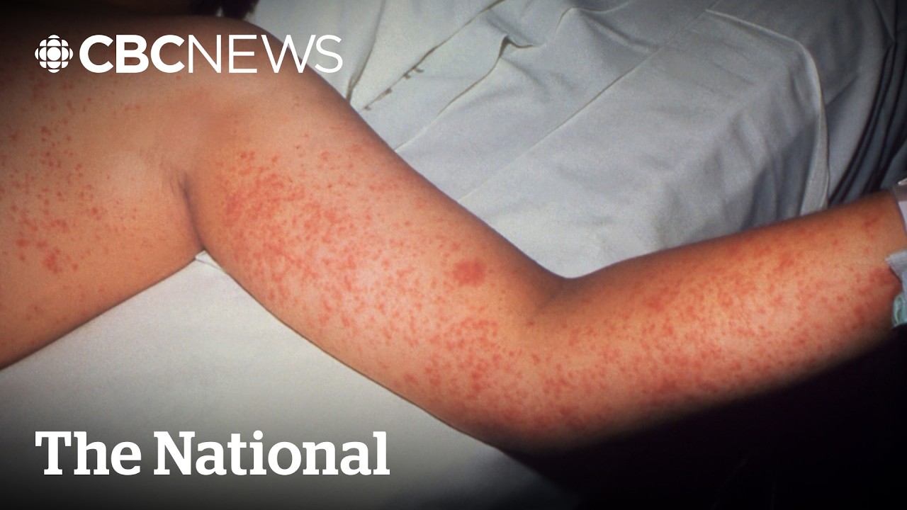 Manitoba leads Canada in measles cases after Brandon superspeader event
