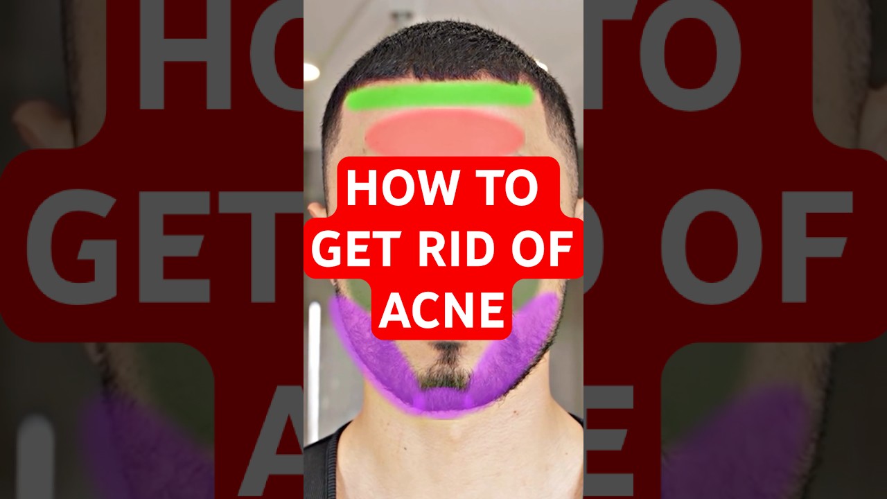WANT TO KNOW HOW TO get rid of acne? 