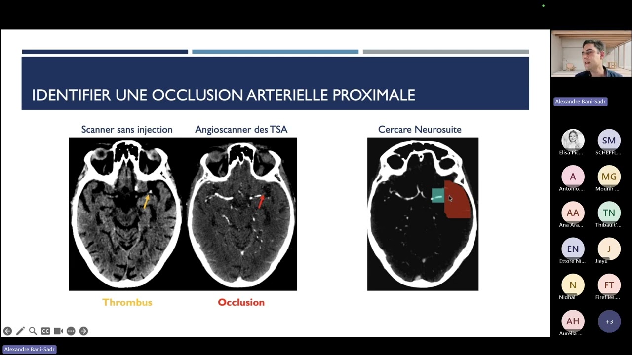 Imagerie de perfusion : un atout pour optimiser la prise en charge de l’AVC