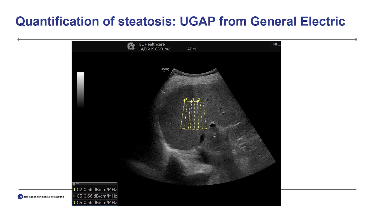 Ultrasound-Guided Attenuation Parameter (UGAP) for the Quantification of Liver Ateatosis Using...