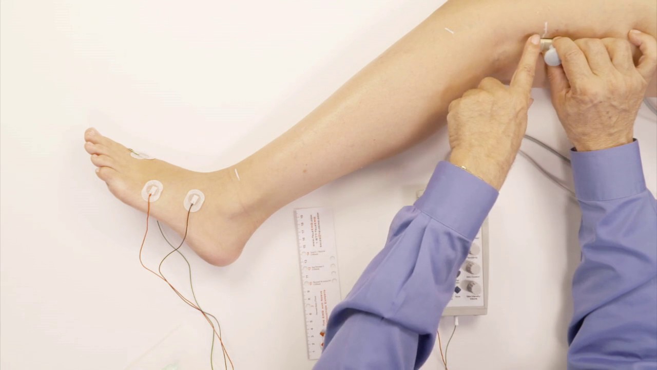 PERONEAL MOTOR WITH F-WAVE