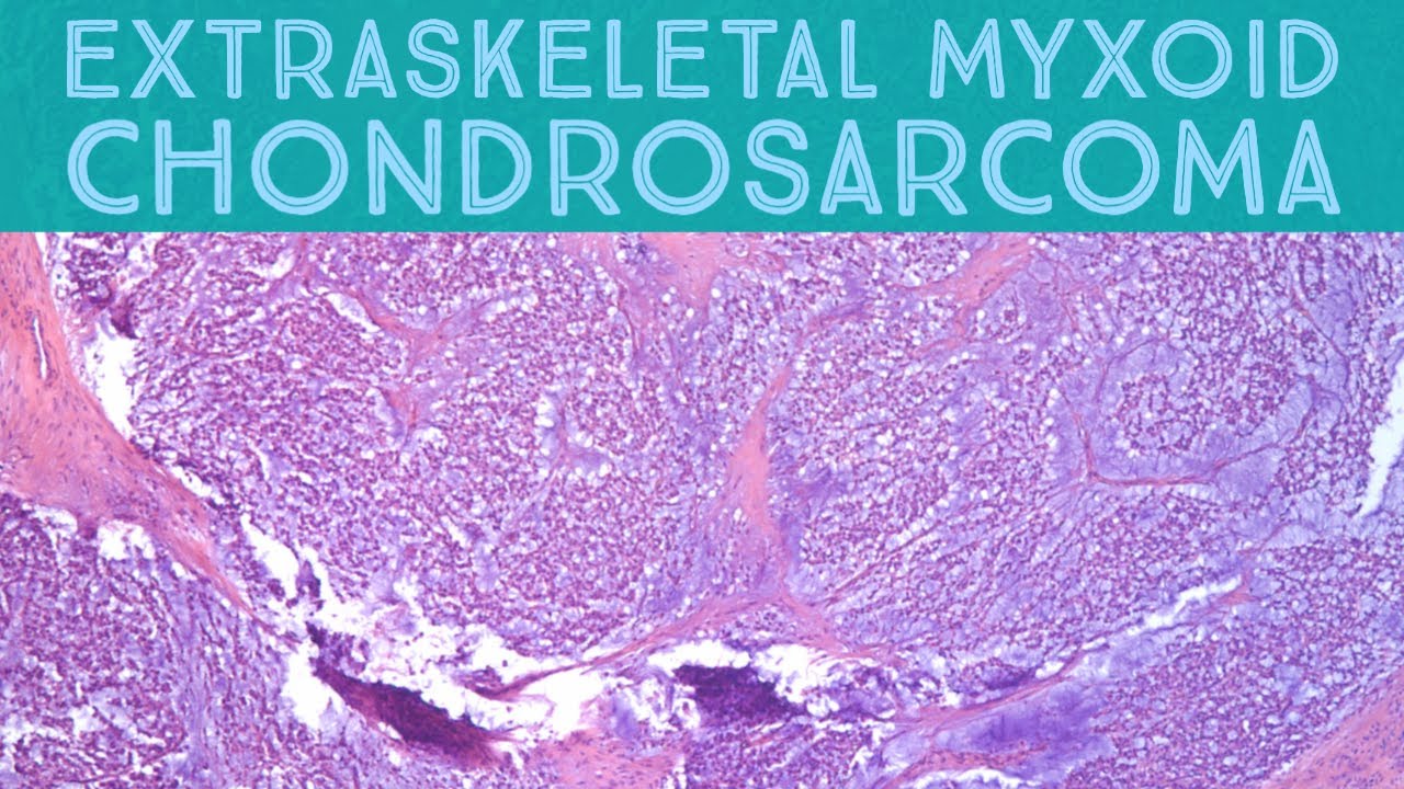 Extraskeletal myxoid chondrosarcoma (rare soft tissue tumor...not a real chondrosarcoma) pathology